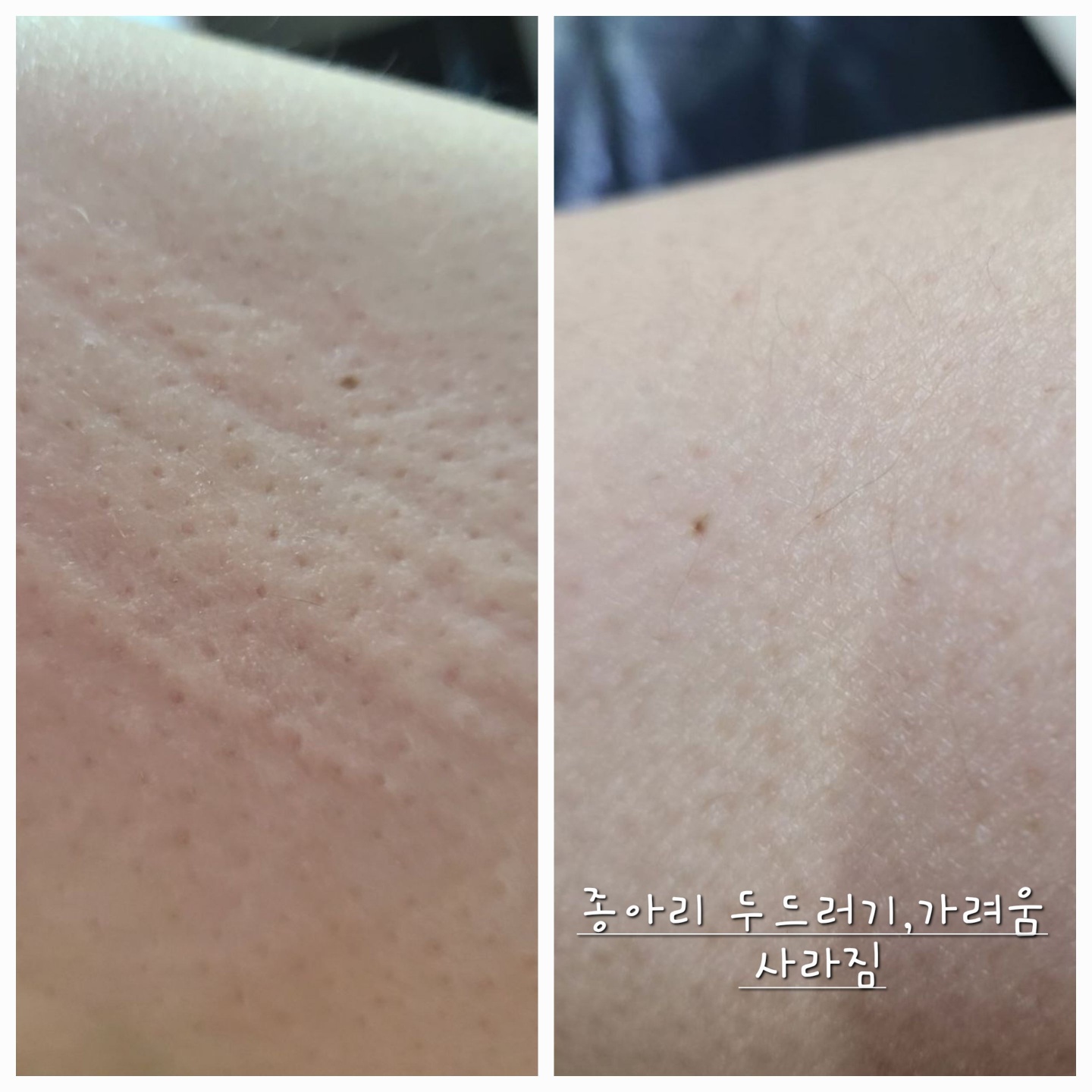 만성적인 피부건조증, 반복되는 아토피, 건선, 습진,소양증의 가려움을 동반하는 피부라면 부작용 걱정없이 젠바이오 크림 하나로 피부 가려움증 케어